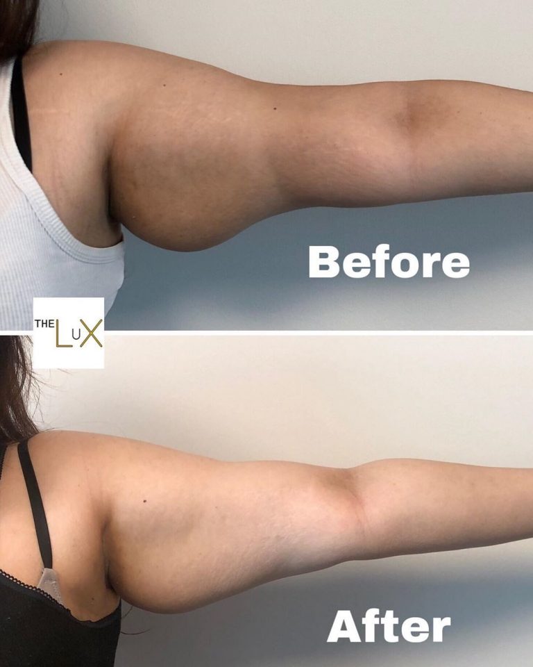 Arm Fat Reduction Treatments The Lux Clinic
