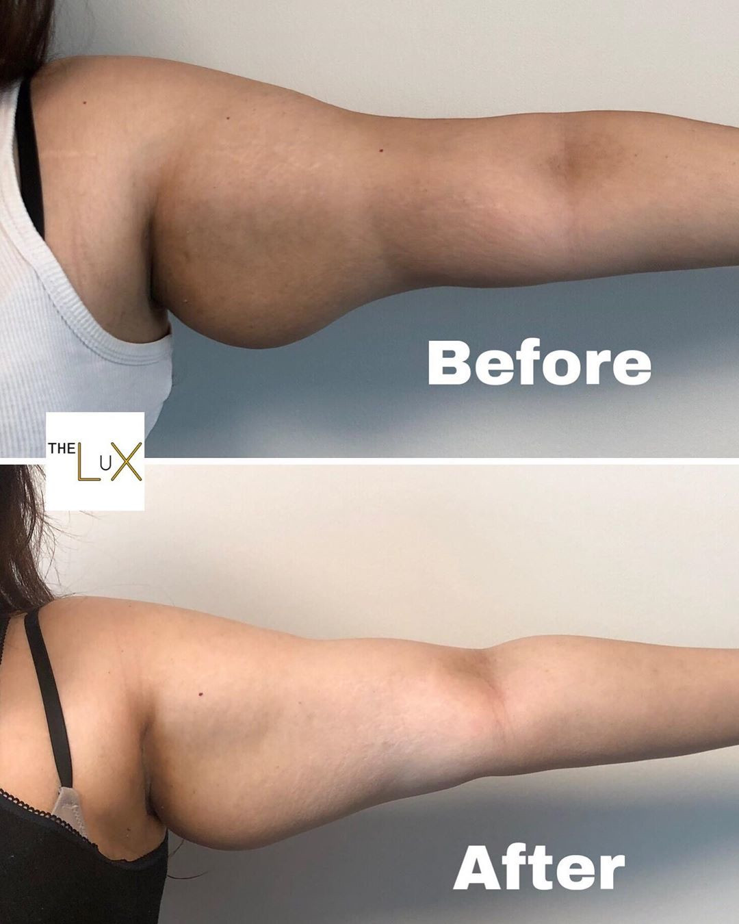Arm Fat Reduction Treatments - The Lux Clinic